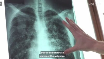 Primul transplant de plămân de porc la om a reușit, organul funcționând timp de nouă zile, într-o inițiativă ce ar putea contribui la soluționarea crizei mondiale de organeea noastră”