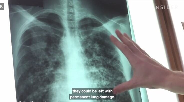 Primul transplant de plămân de porc la om a reușit, organul funcționând timp de nouă zile, într-o inițiativă ce ar putea contribui la soluționarea crizei mondiale de organeea noastră”