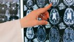 Cercetare: Dieta ketogenică, cu conținut ridicat de grăsimi și redusă în carbohidrați, poate susține sănătatea creierului și încetini deteriorarea cognitivăea noastră”