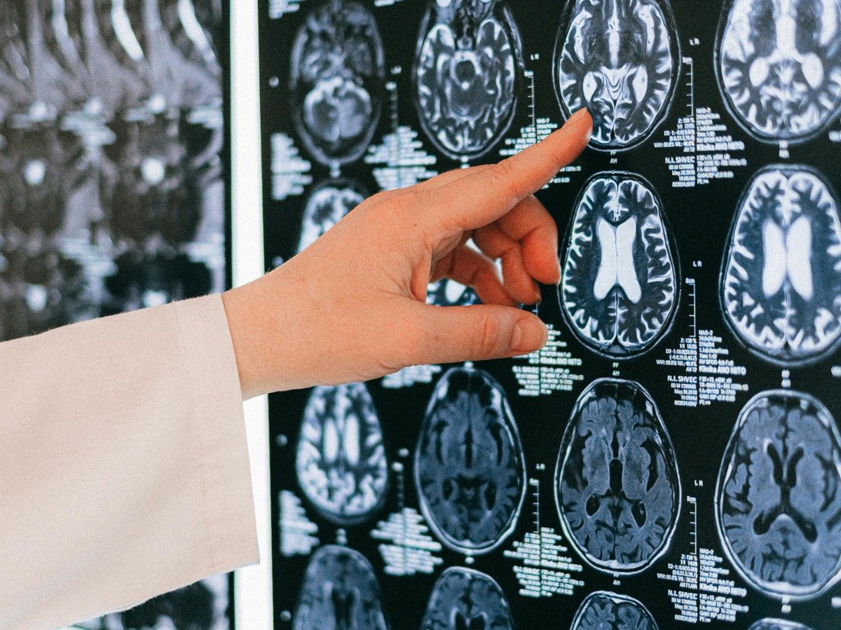 Cercetare: Dieta ketogenică, cu conținut ridicat de grăsimi și redusă în carbohidrați, poate susține sănătatea creierului și încetini deteriorarea cognitivăea noastră”