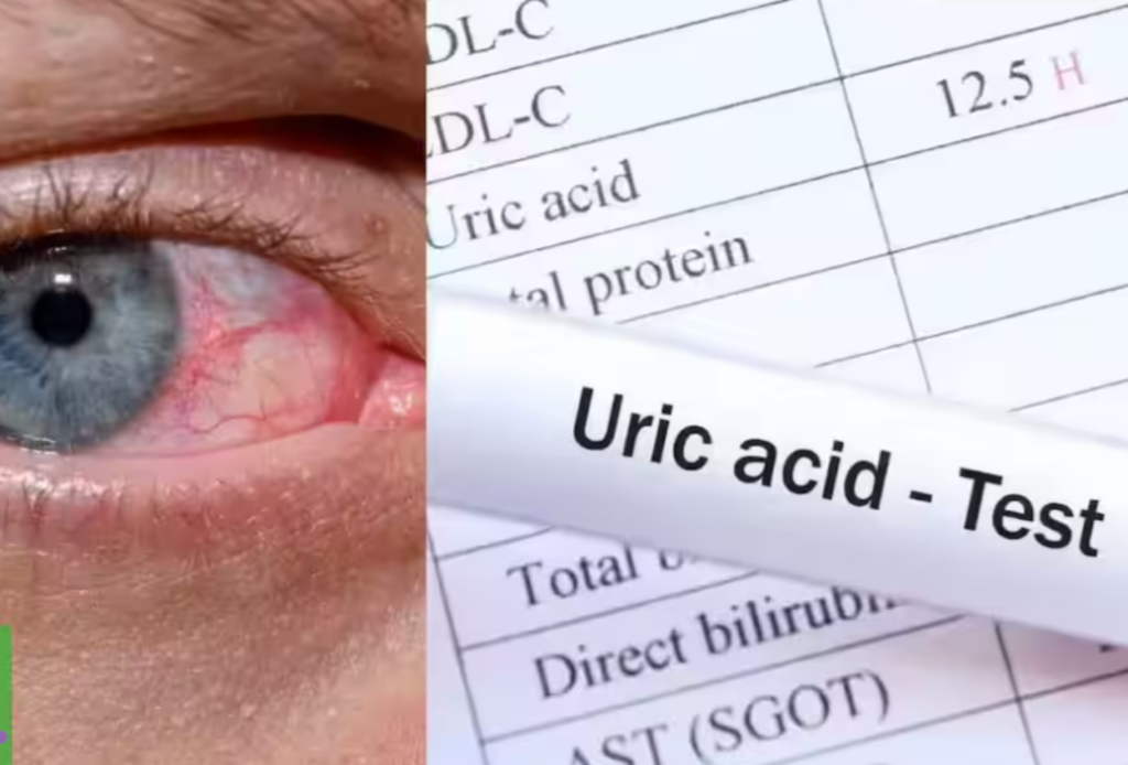 Acidul uric crescut: ce probleme de sănătate poate cauza Nivelul ridicat de acid uric în sânge, o afecțiune cunoscută sub numele de hiperuricemie, poate genera o serie de probleme de sănătate, de la dureri articulare severe la afecțiuni renale