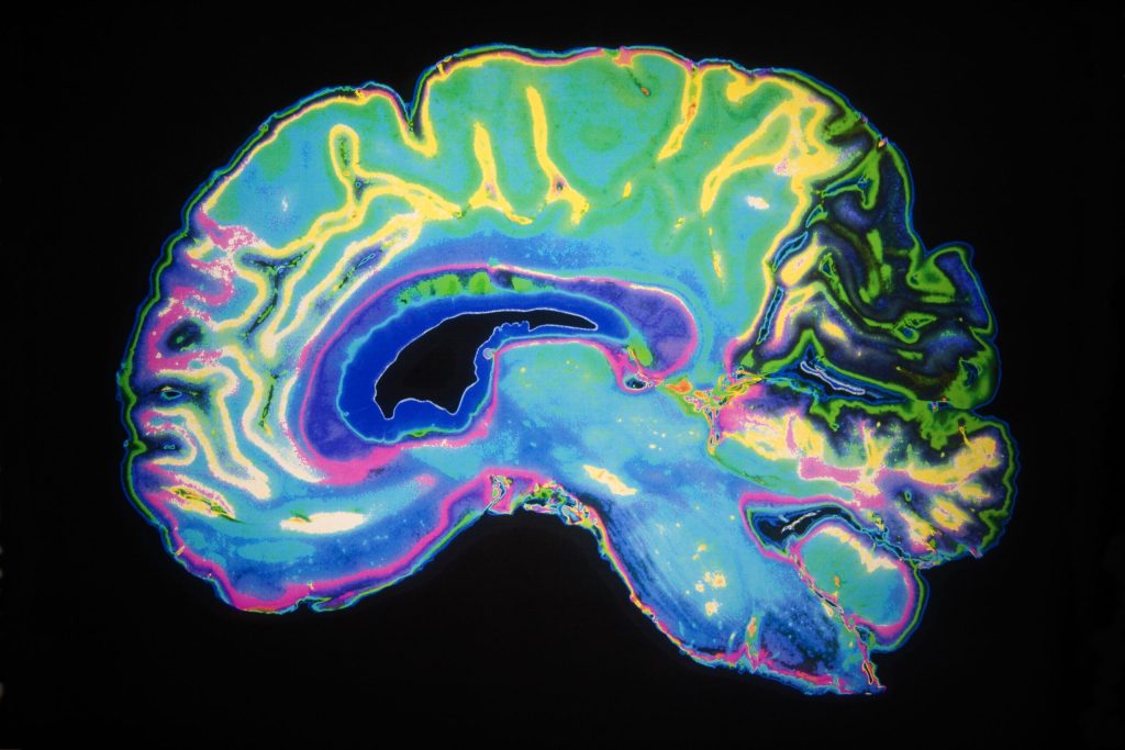 Oamenii de știință au identificat mecanismul prin care creierul se apără de Alzheimer Un studiu recent, realizat de cercetători de la UCLA Health și UC San Francisco, a făcut lumină asupra modului în care anumite celule cerebrale reușesc să reziste acumulării proteinei tau, un factor major în dezvoltarea bolii Alzheimer și a altor forme de demență