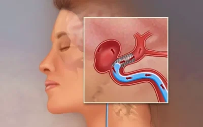 anevrism-1024x538.webp.webp - JurnalUrban