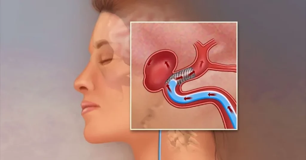 Două simptome care pot ascunde o amenințare cerebrală gravă Un medic neurolog avertizează asupra importanței identificării precoce a unor semne, aparent minore, care pot indica prezența unui anevrism cerebral