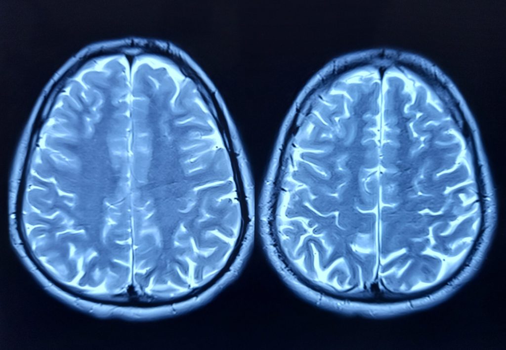 O echipă de cercetători a reușit să conecteze aproximativ 200.000 de celule cerebrale umane la un cip de siliciu și să le antreneze să joace celebrul joc video Doom