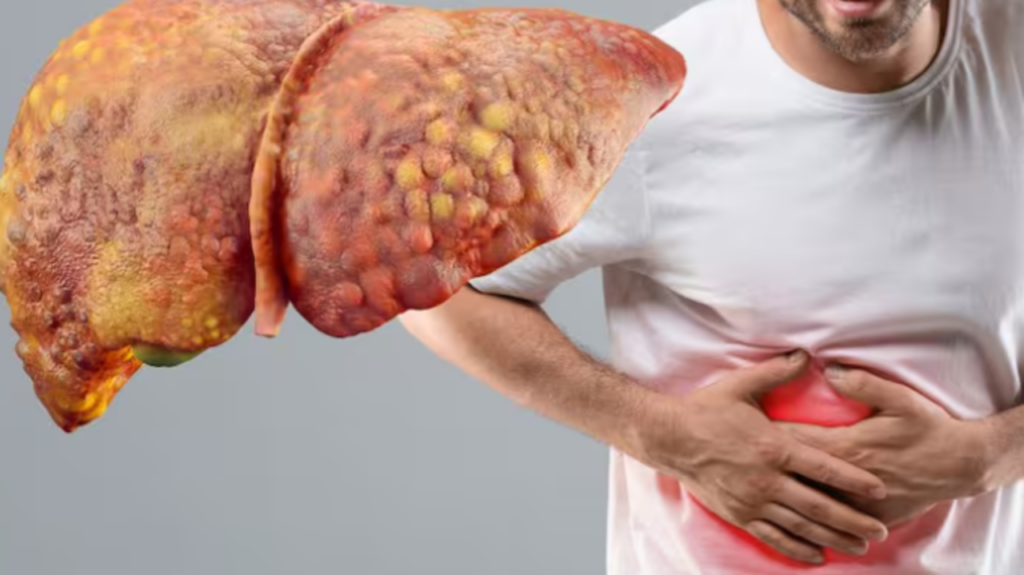 Ficatul gras, o amenințare silențioasă pentru sănătatea românilor Ficatul, organ vital cu multiple funcții, este tot mai expus riscului de afecțiuni, inclusiv steatoza hepatică, cunoscută și sub numele de ficat gras