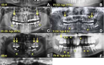 mutatia-genetica-din-spatele-misterioasei-lipse_Graham-Jr-et-al_International-Dental-Journal-2025_de.jpeg - JurnalUrban