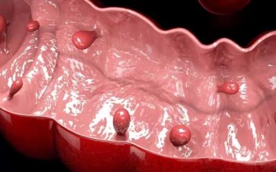 polipi-rectali1-1024x753.jpg - JurnalUrban