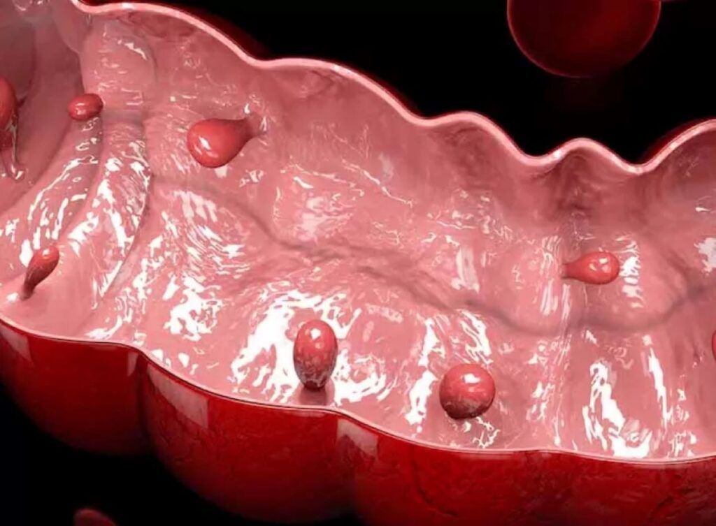 Polipii sesili: Abordarea silențioasă a cancerului colorectal și importanța depistării timpurii Într-o luptă mută cu sănătatea, polipii sesili se ascund în umbra colonului și a rectului, reprezentând o amenințare insidioasă: potențialul de a evolua spre cancer colorectal