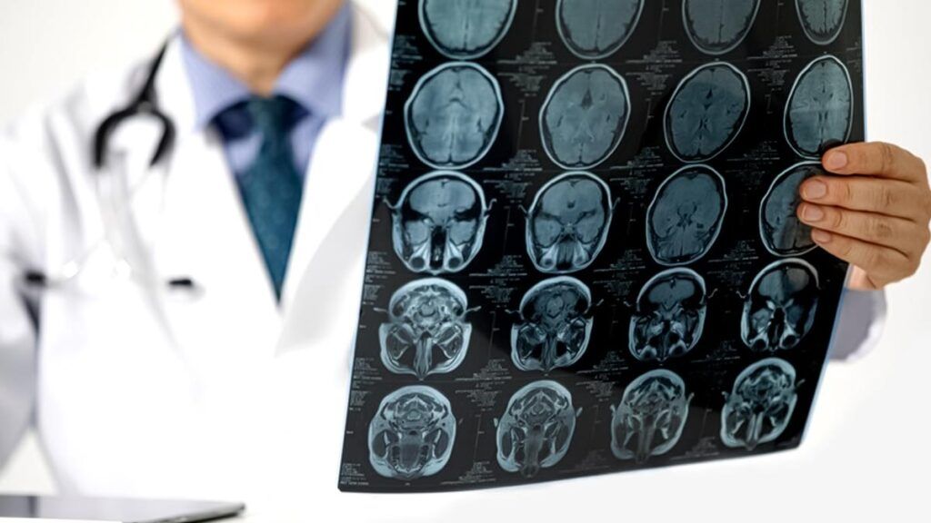 Un indicator ignorat în analizele uzuale ar putea oferi o perspectivă mai clară asupra riscului de accident vascular cerebral Monitorizarea regulată a colesterolului, o practică uzuală pentru mulți dintre noi, s-ar putea să nu fie suficientă pentru a evalua corect riscul de accident vascular cerebral (AVC)