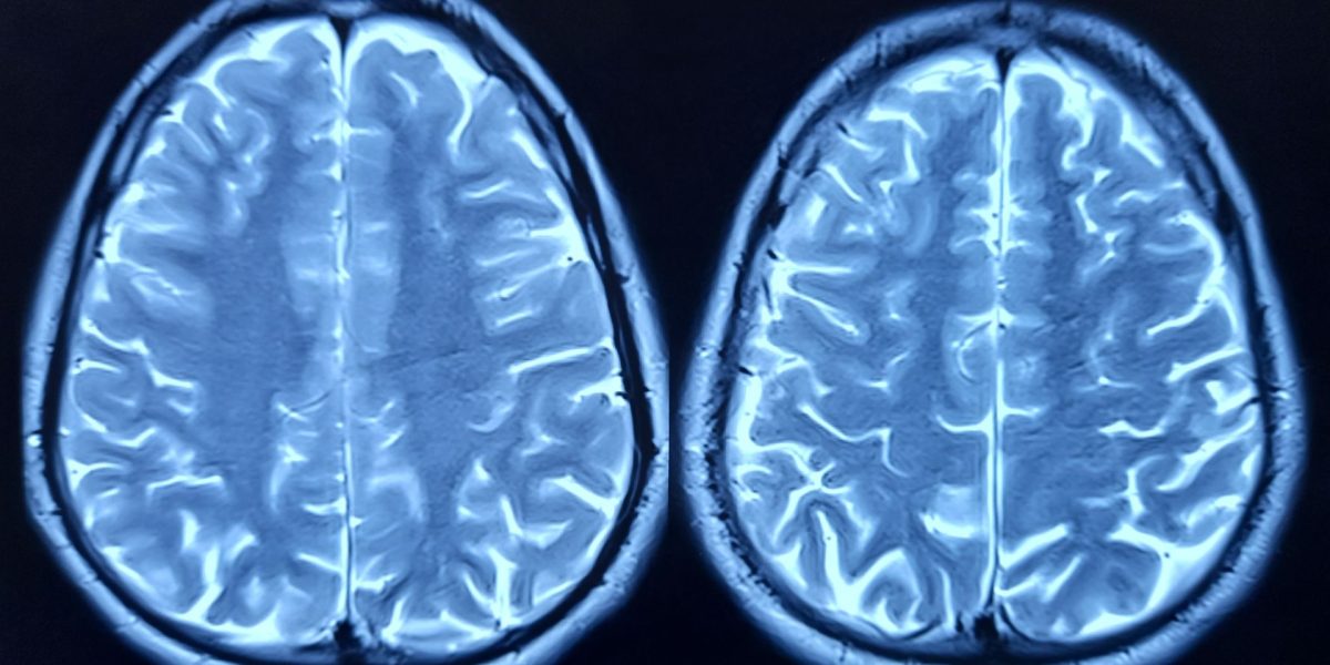 Cercetătorii au identificat o proteină cheie, numită FTL1, responsabilă pentru accelerarea îmbătrânirii creierului