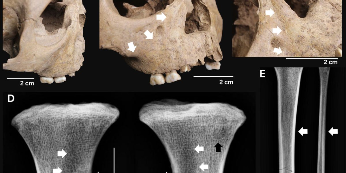 Dinții copiilor antici: Boala mortală care bântuia acum 4000 de ani