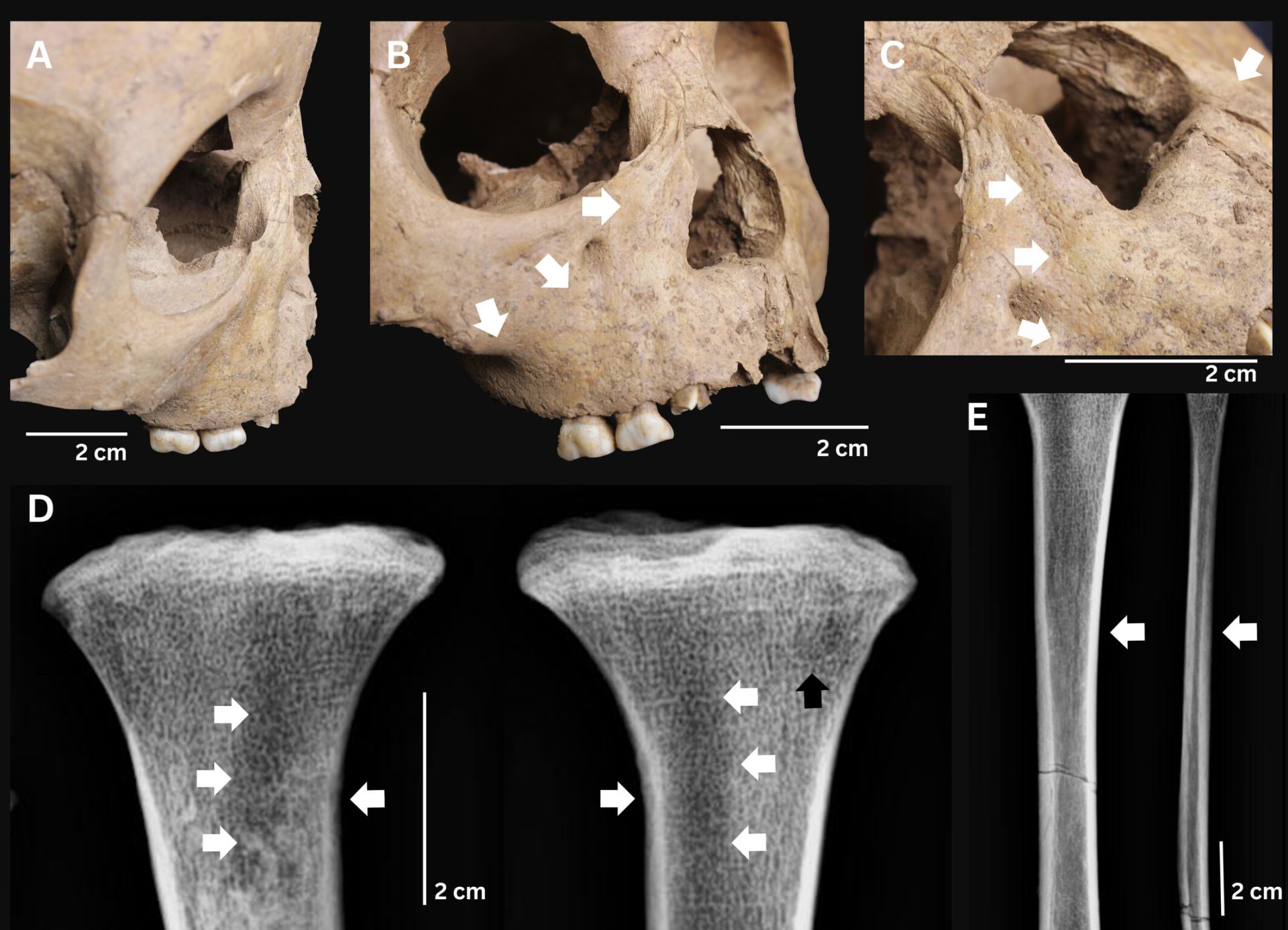 Arheologii din Vietnam au descoperit dovezi ale unei boli extrem de grave în dinții unor copii antici, o descoperire care ar putea schimba ceea ce se credea despre originea sifilisului