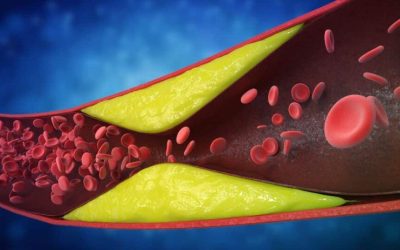 Semnele arterelor blocate: Cardiologii trag semnalul de alarmă! Atenție