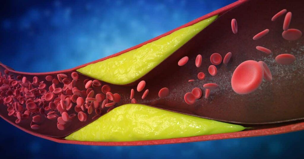 Semnele arterelor blocate: Cardiologii trag semnalul de alarmă! Atenție