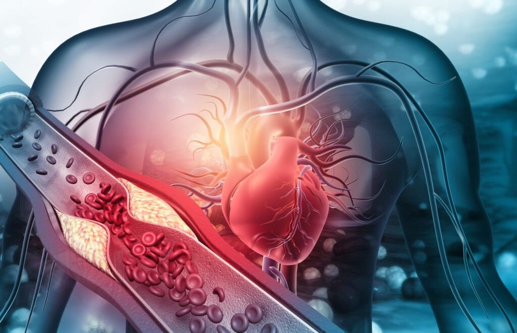 Ateroscleroza lovește tăcut: Nu ignora aceste semne, e fatală!
