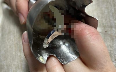 Accidente casnice grave la Iași: Două femei, internate de urgență