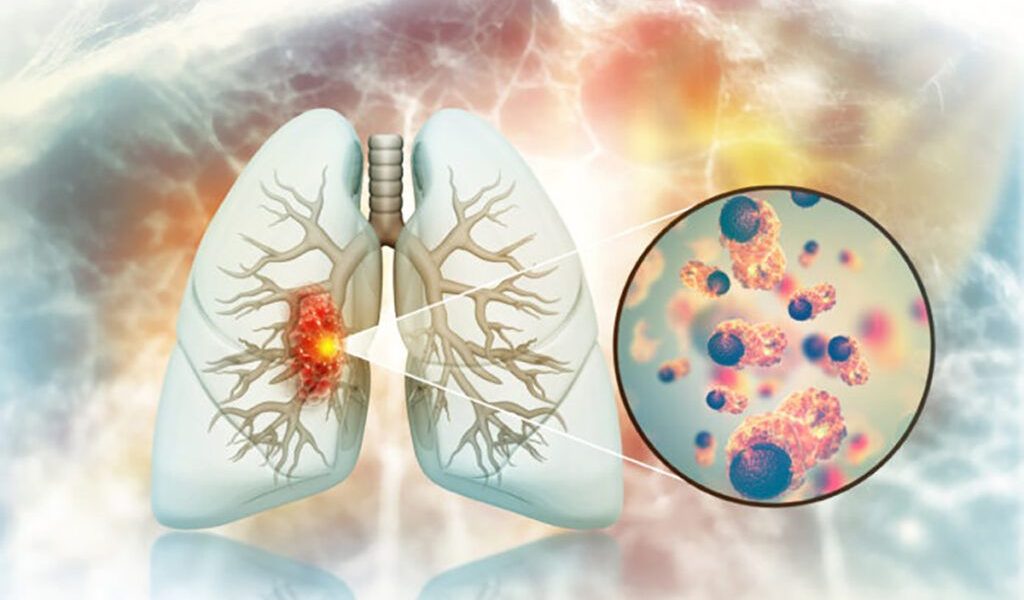 Cancer pulmonar la nefumători: Medici, uimiți de cauze