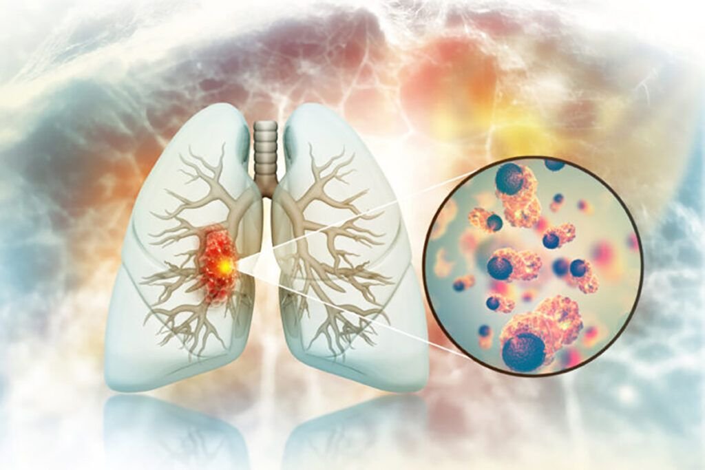 Cancer pulmonar la nefumători: Medici, uimiți de cauze