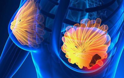 Semnele cancerului de sân: 5 simptome la care trebuie să fii atentă acum