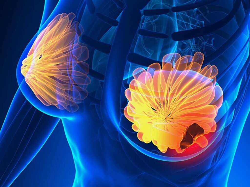 Semnele cancerului de sân: 5 simptome la care trebuie să fii atentă acum