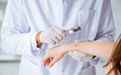 Ectima: Cauze, simptome și tratamente eficiente pentru afecțiune