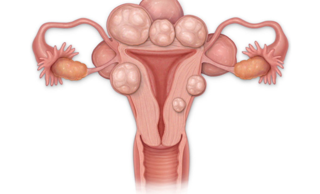 Atenție gravă: Fibromul uterin, inamicul ascuns al sarcinii