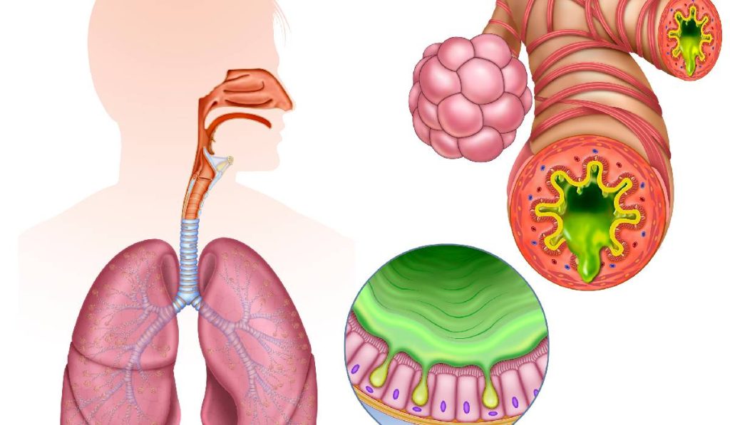 Inflamația cronică, inamicul ascuns: Atacă sănătatea modernă