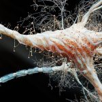 Inflamația intestinală, legătura periculoasă cu scleroza multiplă