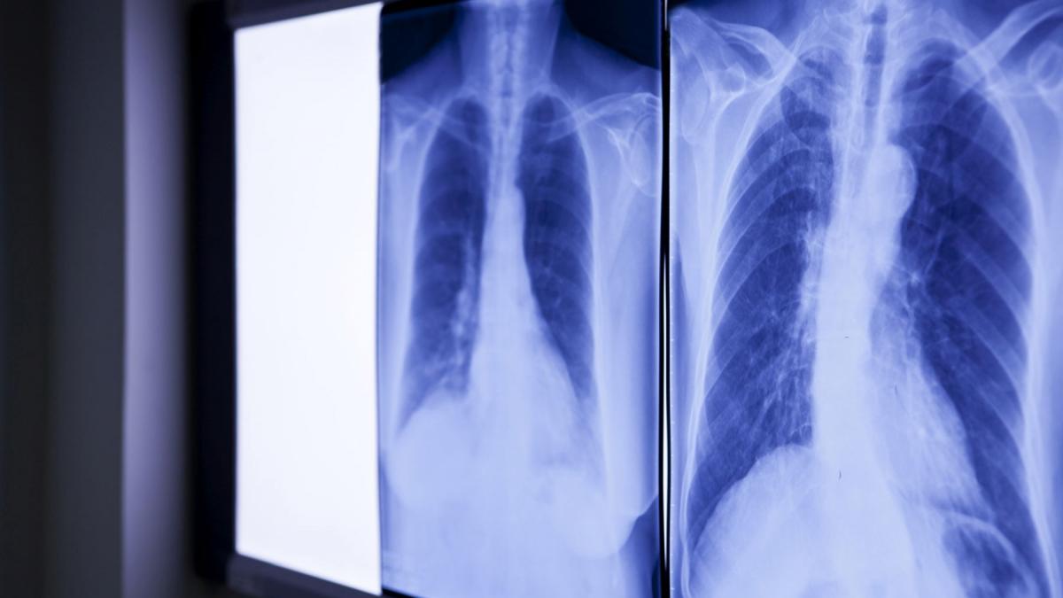 Medici, șocați: Ce au găsit în abdomenul unui bărbat. E de 20 de ani acolo