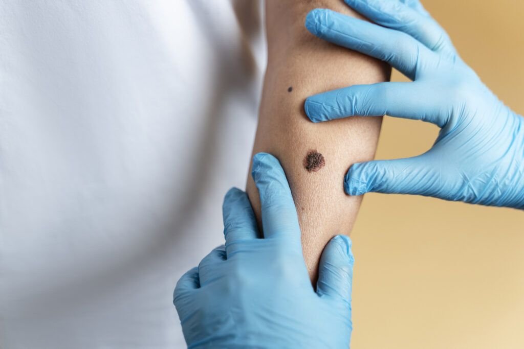 O femeie în vârstă de 37 de ani, din Plymouth, Anglia, și-a pierdut viața din cauza melanomului, o formă gravă de cancer de piele, după ce afecțiunea a fost ignorată în faza incipientă
