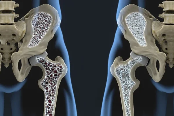 Un tratament revoluționar promite oase mai puternice, inclusiv în osteoporoză