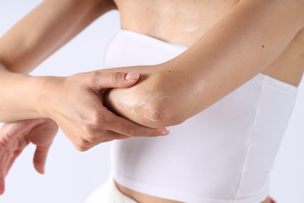 Piele uscată pe brațe și picioare? 5 obiceiuri care o înrăutățesc