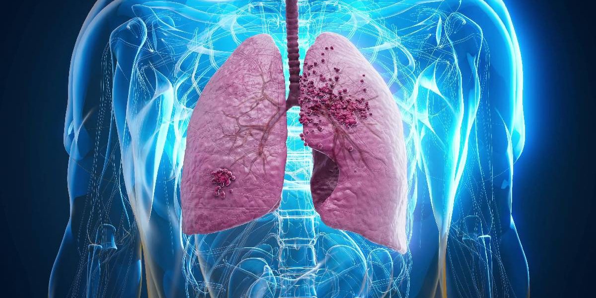 MUNCĂ ȘI INFORMARE. Cancerul pulmonar: Adevăruri și mituri despre boală