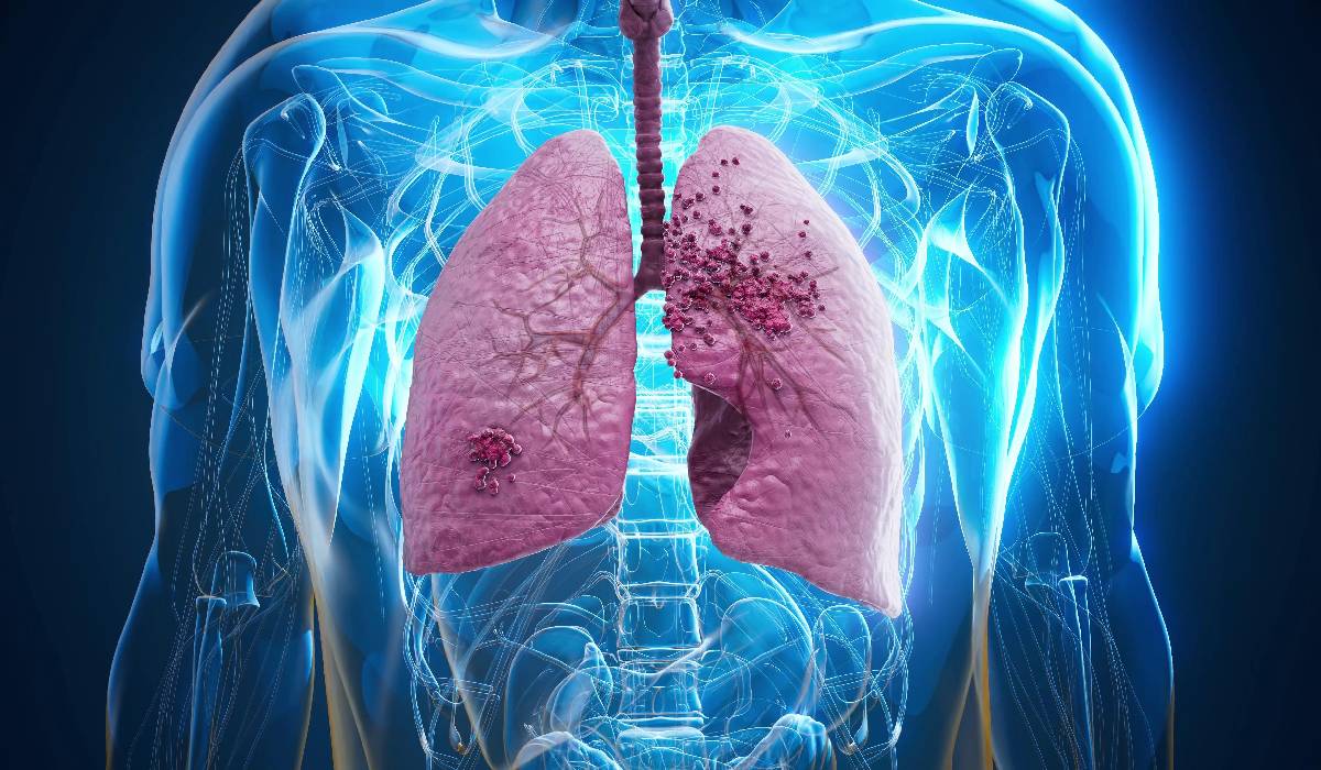 Cancerul pulmonar, o boală cu impact major la nivel mondial, continuă să ridice semne de întrebare și să stârnească o serie de mituri