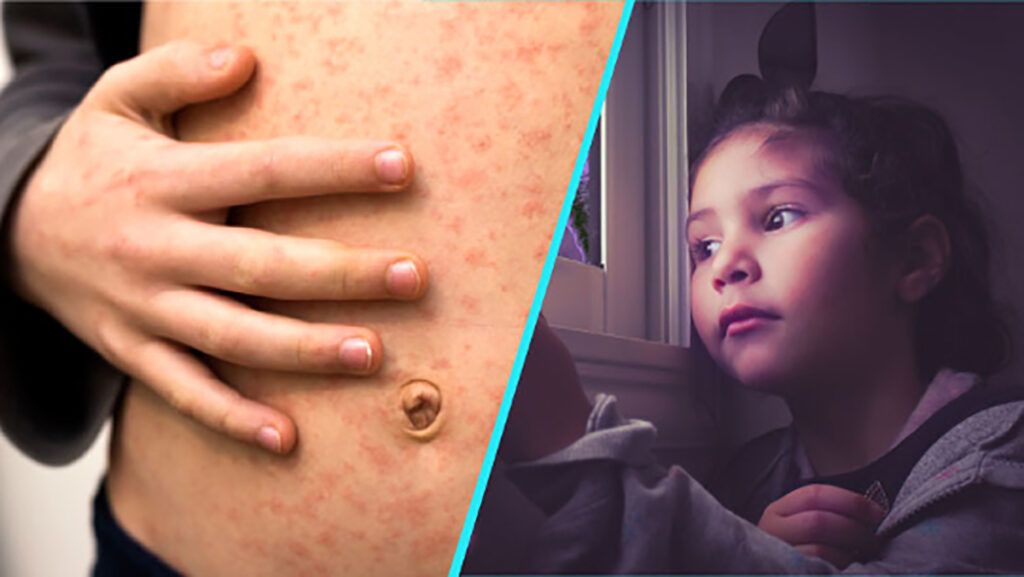 Rujeolă, gripă și refuzul vaccinării: Drama copiilor în România
