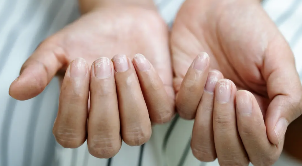 Unghiile Terry, semnul ascuns al bolilor grave: Ce trebuie să știi