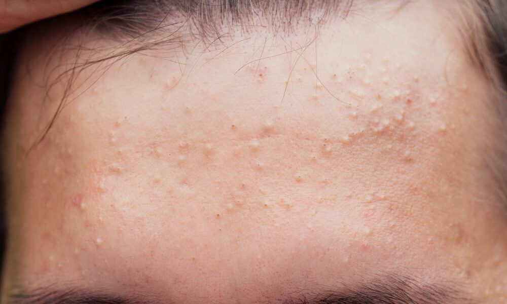 Acid salicilic: Protocolul anti-acnee în 3 pași. Ghid practic