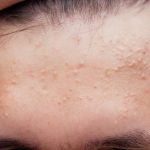 Acid salicilic: Protocolul anti-acnee în 3 pași. Ghid practic