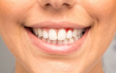 Sângerarea gingiilor: Semn de alarmă pentru boli grave