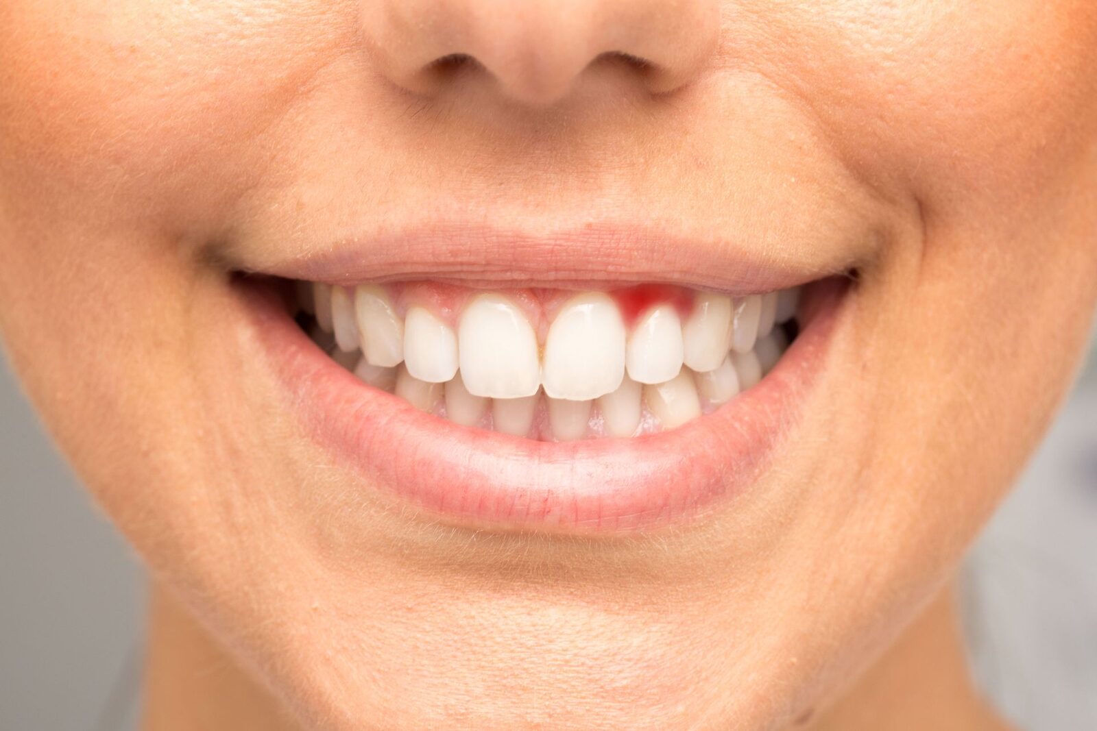 Sângerarea gingiilor: Semn de alarmă pentru boli grave