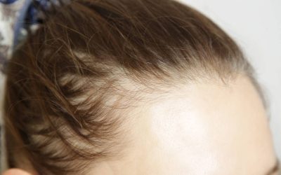 Injecții slăbit: Te lasă fără păr? Explicația alopecia