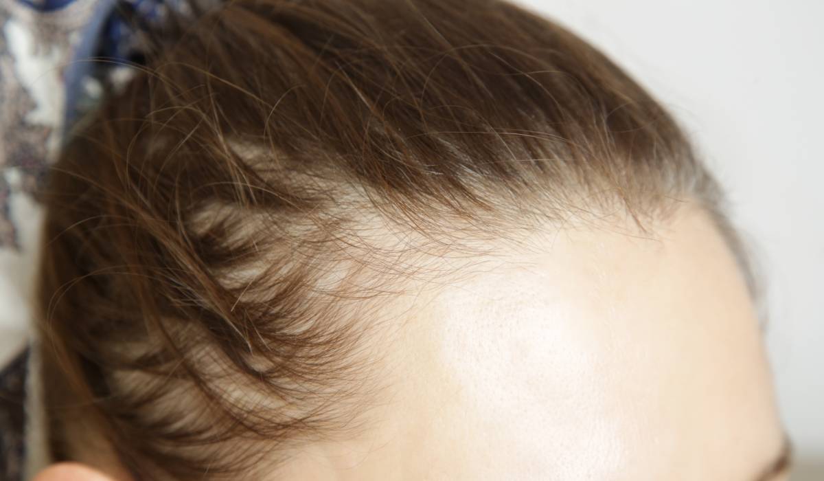 Injecții slăbit: Te lasă fără păr? Explicația alopecia