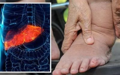 Picioarele anunță ficat gras. Gastroenterolog: Nu ignorați semnul