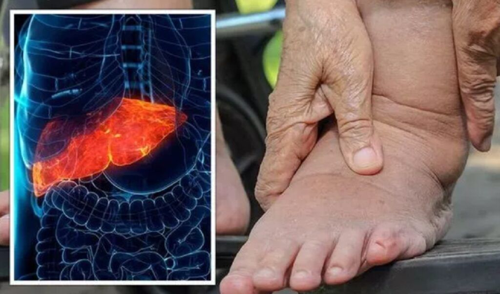 Picioarele anunță ficat gras. Gastroenterolog: Nu ignorați semnul