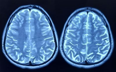 Depresia: Creierul tău riscă să piardă neuroni noi