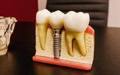 Implant dentar în rate: Soluția accesibilă pentru un zâmbet perfect