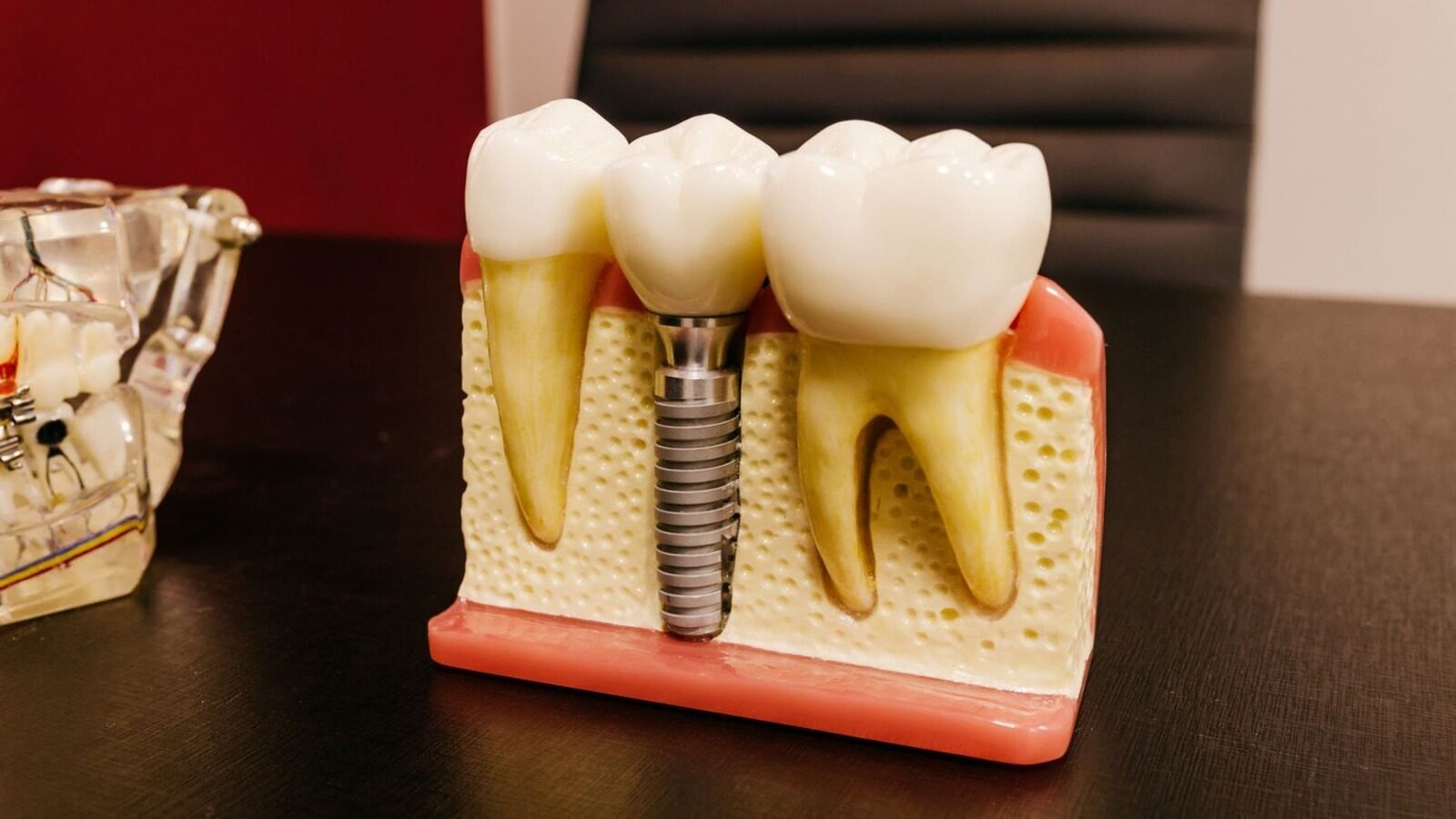 Implant dentar în rate: Soluția accesibilă pentru un zâmbet perfect