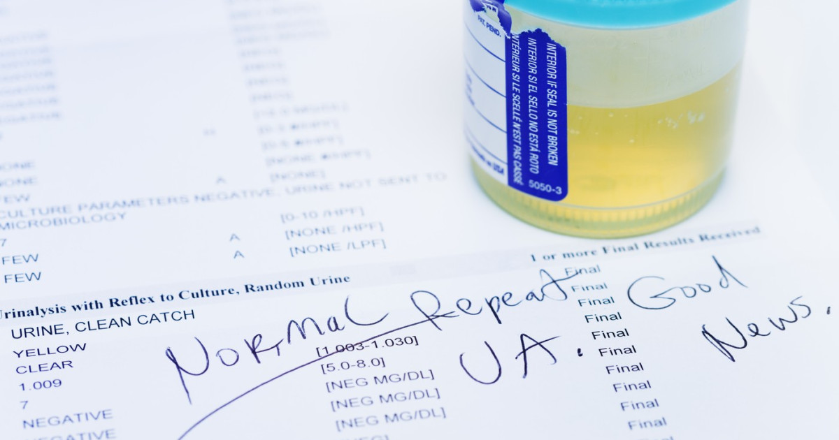 Test Urină: Depistează 9 din 10 Câncer Vezică